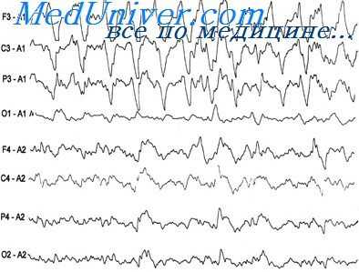 эпилептические приступы