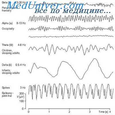 фармакологическая активация при эпилепсии