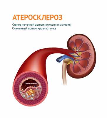 Атеросклероз почечной артерии.jpg