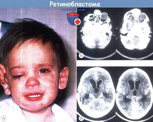 Ретинобластома у ребенка