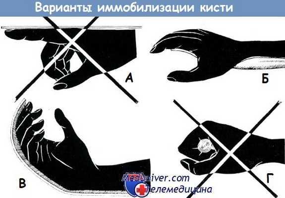 Варианты иммобилизации кисти