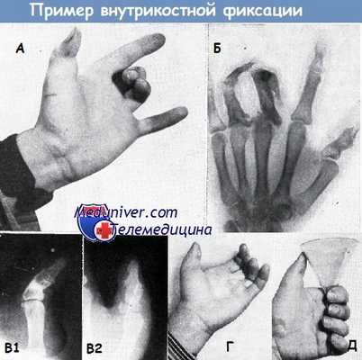 Пример внутрикостной фиксации