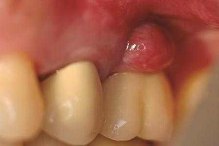 Профилактика неудачной имплантации до этапа установки