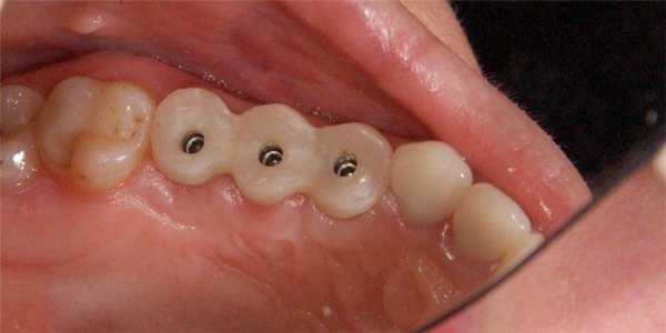 Винтовая фиксация металлокерамических коронок на импланты