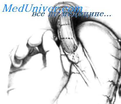 фундопликация по ниссену