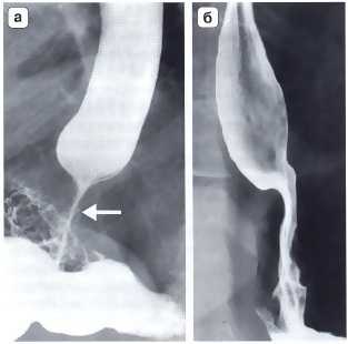 Рис. 2. Рентгенограмма. Осложнения после фундопликации по Ниссену: а) дисфагия, обусловленная излишне туго сформированной манжеткой; б) дисфагия, вызванная излишней длинной фундопликационной манжеткой. В обоих случаях видны признаки нарушения проходимости в области пищеводно-желудочного перехода и супрастенотическое расширение пищевода выше наложенной манжетки