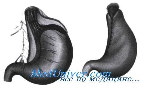 фундопликация по Черноусову