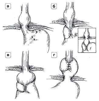 Рис. 4. Осложнения после фундопликации по Ниссену: а) полный разворот манжетки при прорезывании швов; б) соскальзывание; в) сформированная вокруг кардиального отдела желудка манжетка; г) втягивание антирефлюксной манжетки в заднее средостение при укорочении пищевода