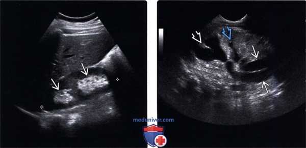 УЗИ при удвоении мочеточника