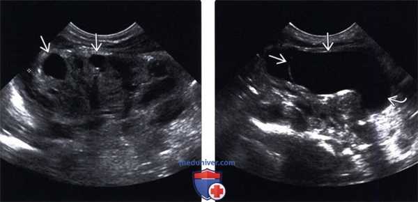 УЗИ при эктопии мочеточника