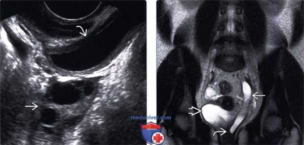 УЗИ при эктопии мочеточника
