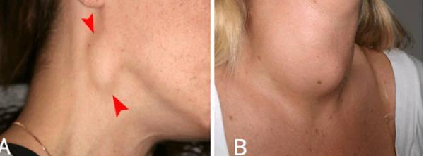 Заболевания мягких тканей шеи