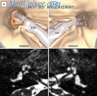 исследование спонтанного нистагма