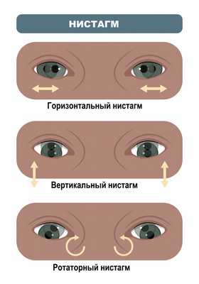 Нистагм.jpg