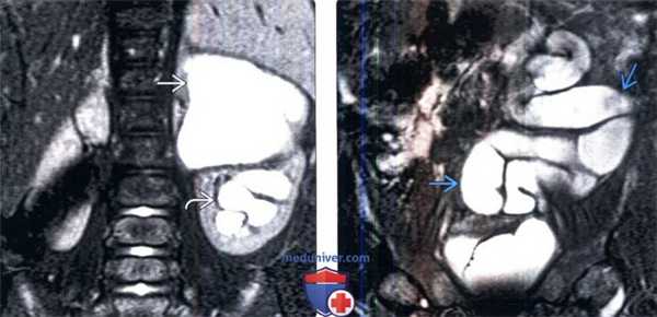МРТ при удвоении и эктопии мочеточника