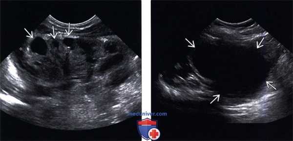 УЗИ при удвоении мочеточника