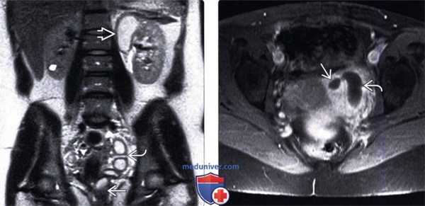 УЗИ при эктопии мочеточника