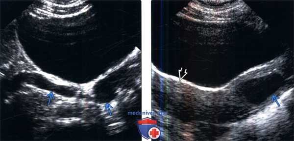 УЗИ при удвоении и эктопии мочеточника
