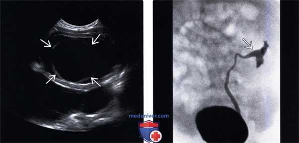 УЗИ при удвоении мочеточника