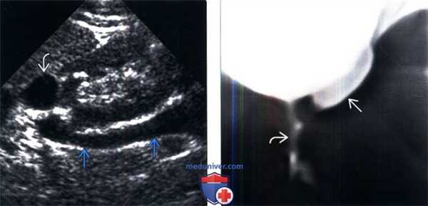 УЗИ, урография при удвоении и эктопии мочеточника