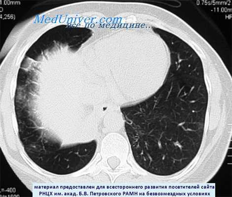 КТ карциноида легкого