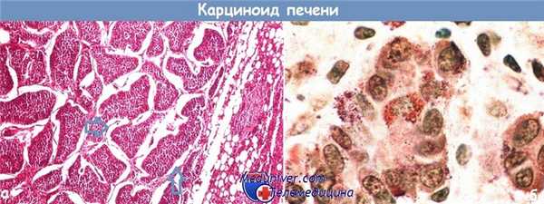 Карциноид печени