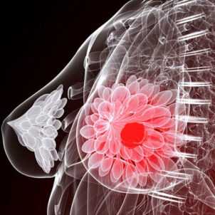 Причины и факторы риска развития рака молочной железы