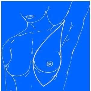 Рак молочной железы