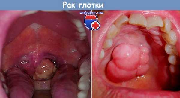 Рак глотки