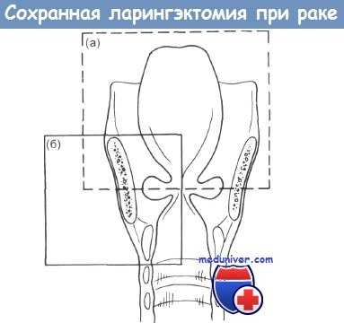 Ларингэктомия при раке