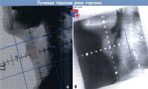 Лучевая терапия рака гортани