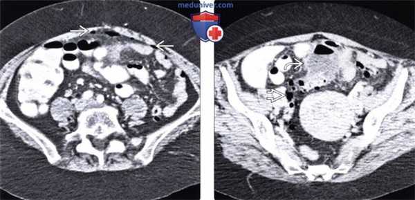 Рентгенограмма, КТ, МРТ, УЗИ при внутрибрюшном абсцессе