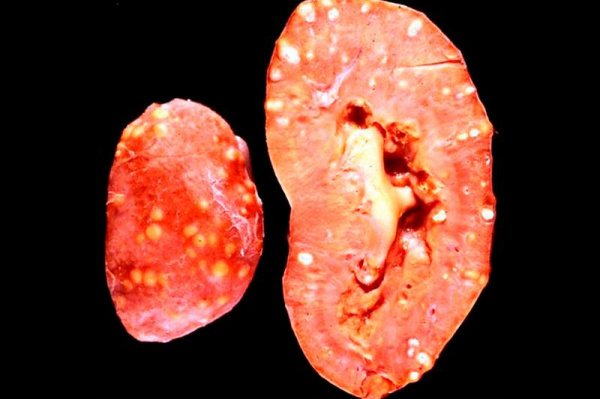 Карбункул почки