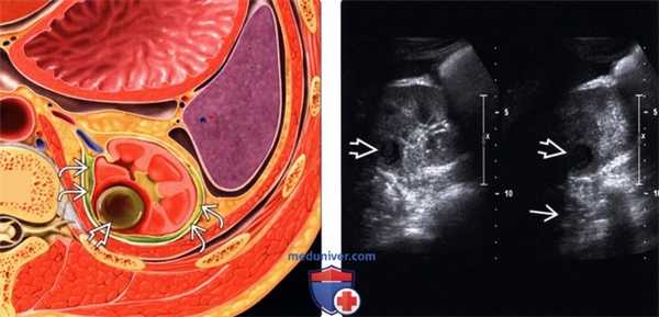 УЗИ, МРТ при абсцессе почки