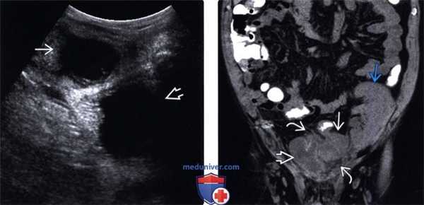 Методы обследования абсцесса брюшной полости