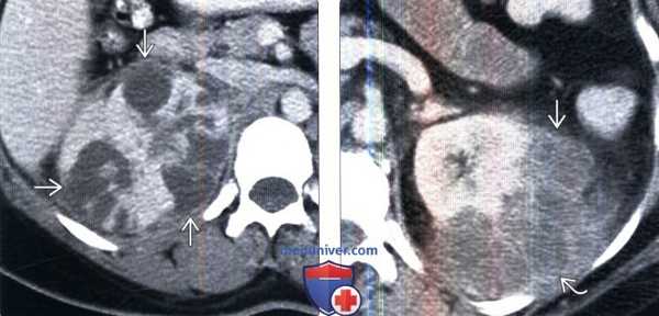 КТ при абсцессе почки