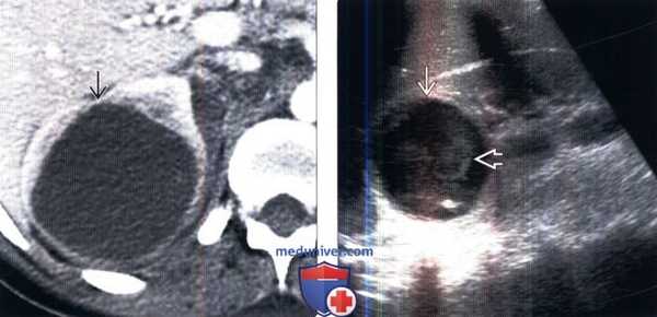 КТ, УЗИ при абсцессе почки