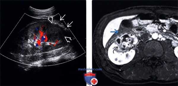 УЗИ, МРТ при абсцессе почки