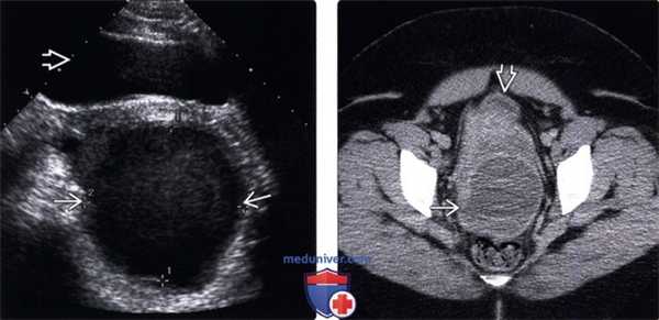 Методы обследования абсцесса брюшной полости