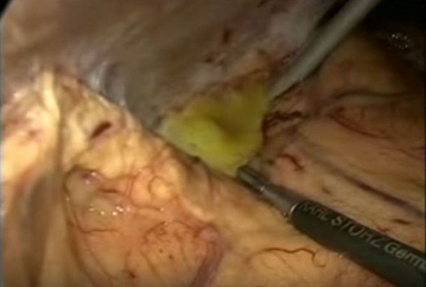 Забрюшинный абсцесс