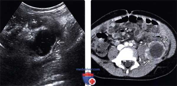 Методы обследования абсцесса брюшной полости