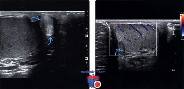 УЗИ при аденоматозной опухоли мошонки