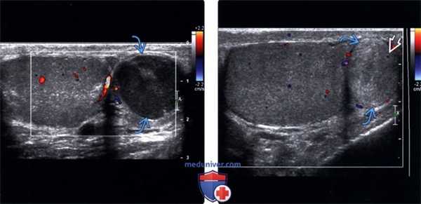 УЗИ при аденоматозной опухоли мошонки