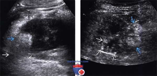 Методы обследования ангиомиолипомы почки