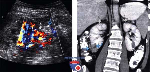 Методы обследования ангиомиолипомы почки