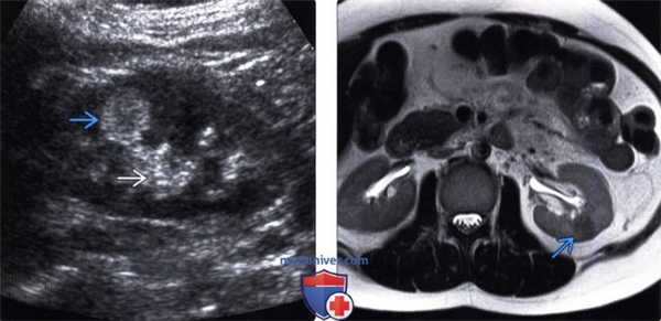 Методы обследования ангиомиолипомы почки