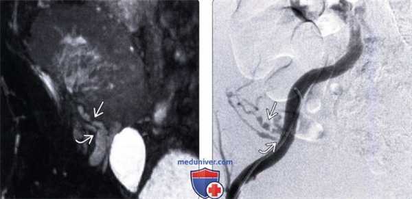 Методы обследования стеноза почечной артерии трансплантата почки