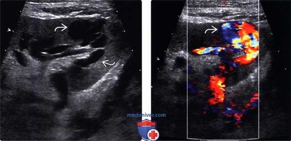 Артериовенозная фистула