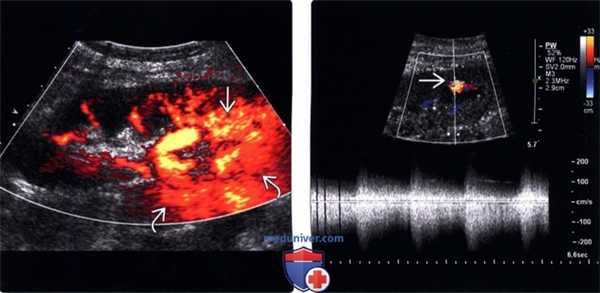 Артериовенозная фистула