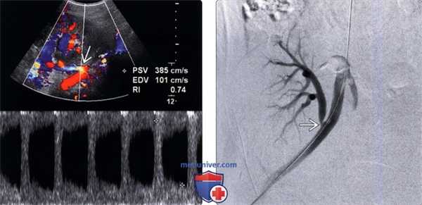 Методы обследования стеноза почечной артерии трансплантата почки